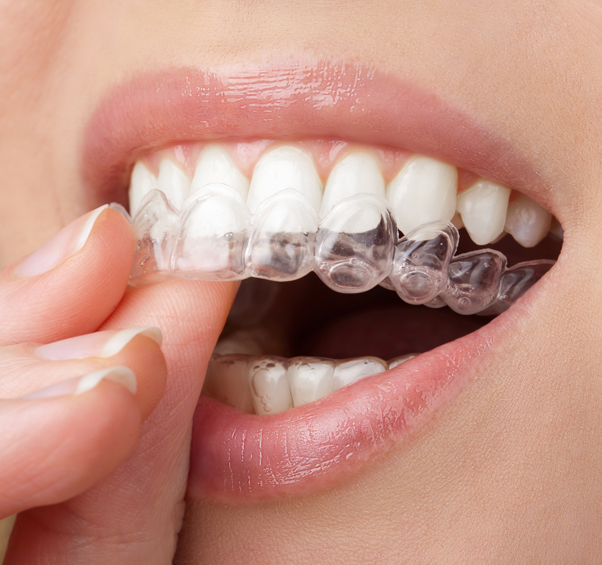 Kaj je dobro vedeti, preden se odločimo za Invisalign zobni aparat?